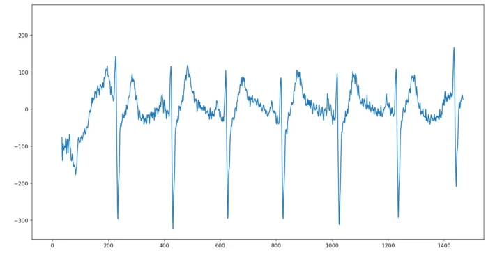 Exemple du signal EKG