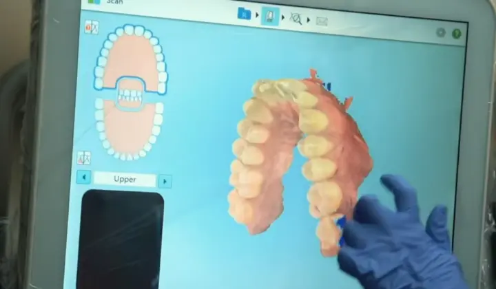 scan 3D intra-oral scan 3D intra-oral